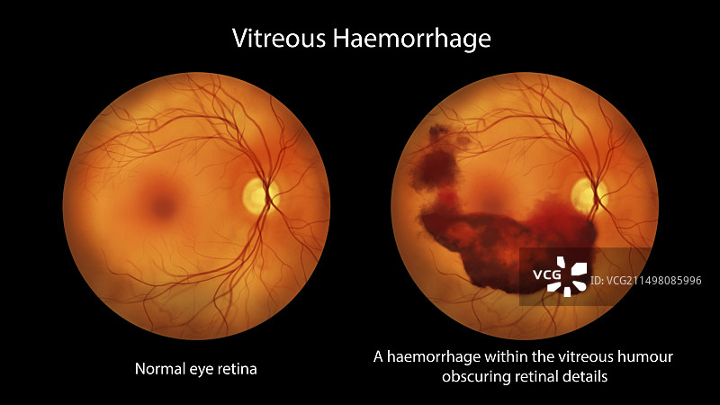 玻璃体出血插图图片素材