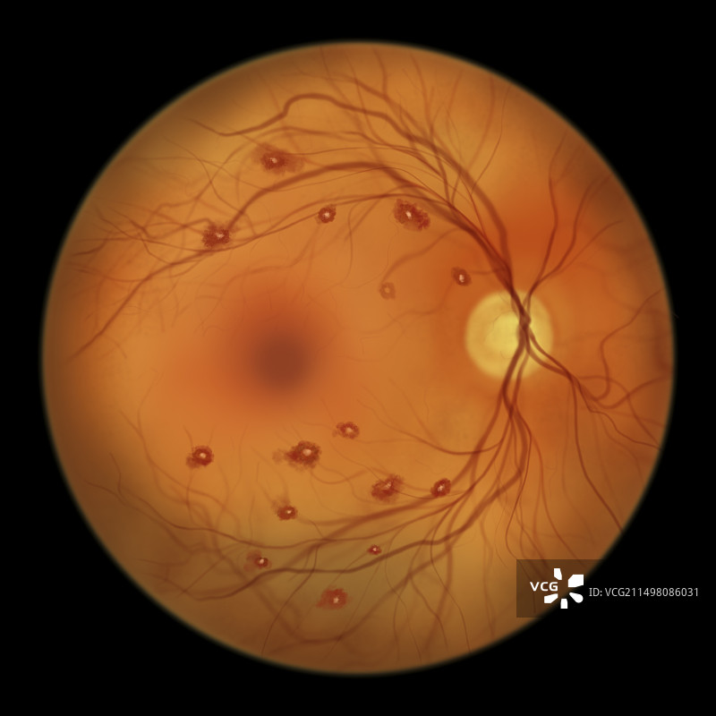 视网膜上的罗斯斑点图片素材