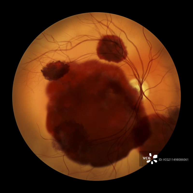 视网膜下出血插图图片素材