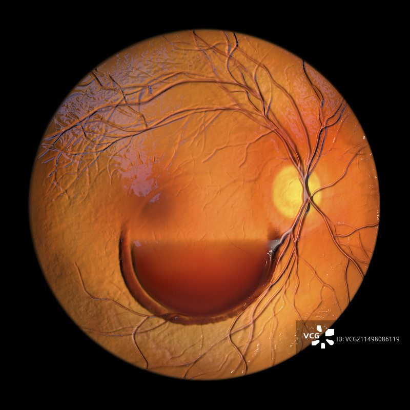 瓦尔萨瓦视网膜病变插图图片素材