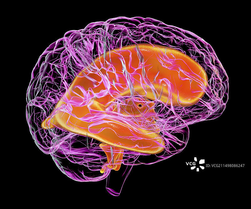 扩大的儿童脑室，图示图片素材