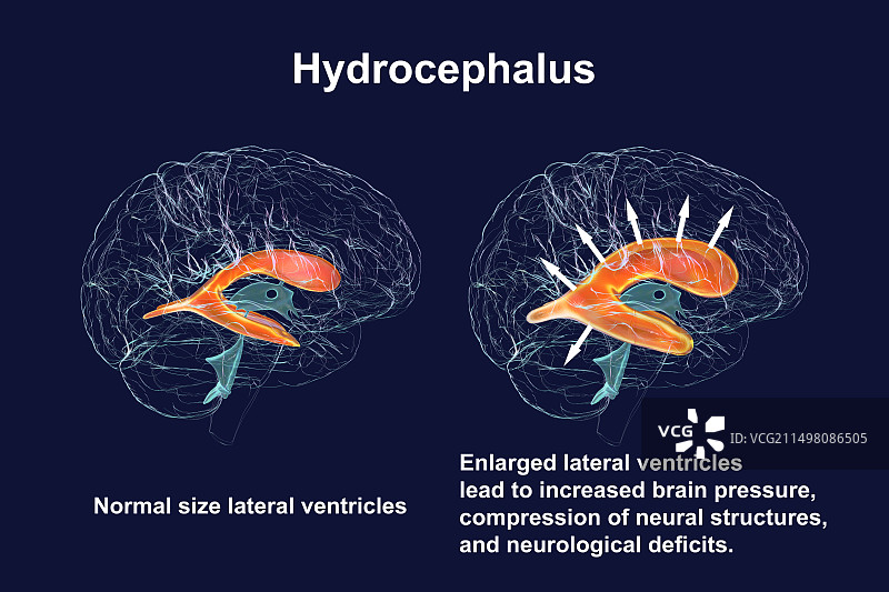 扩大和正常的大脑侧脑室，图示图片素材