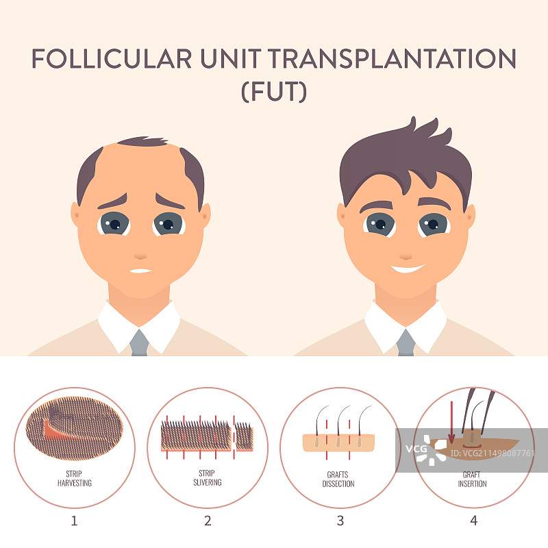 毛发移植概念图图片素材