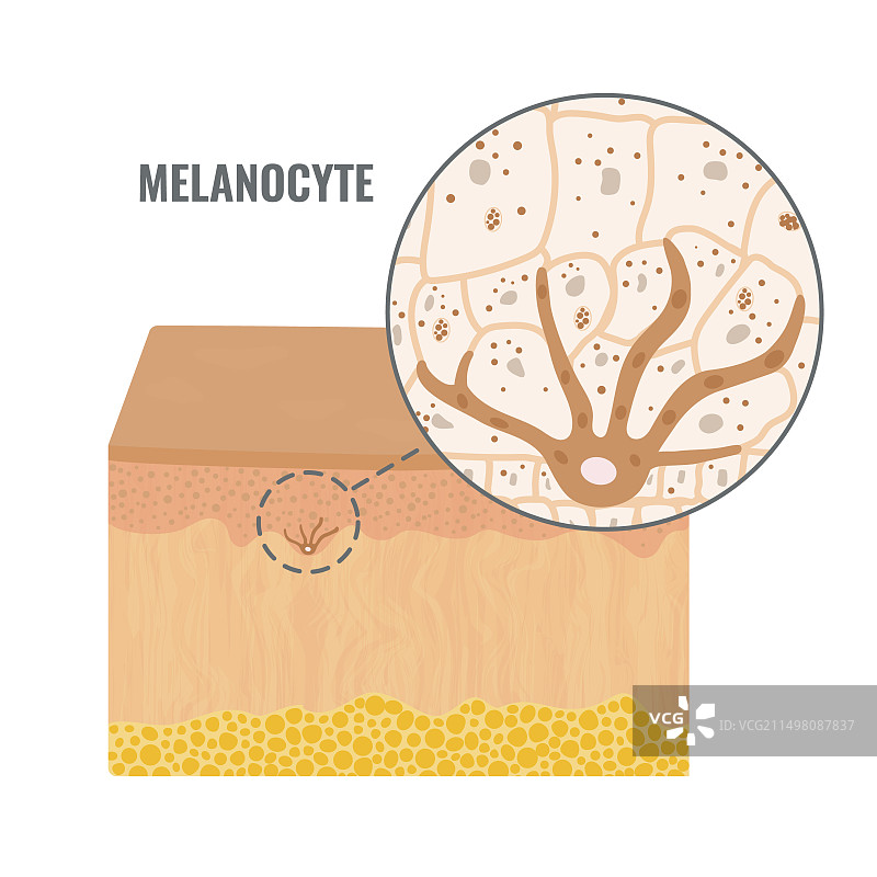 皮肤色素沉淀概念图图片素材