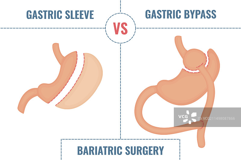 减肥手术概念图图片素材