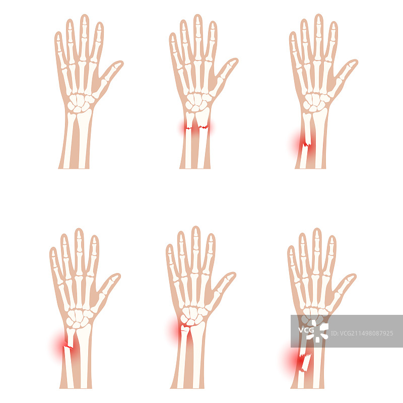 手腕骨折插图图片素材