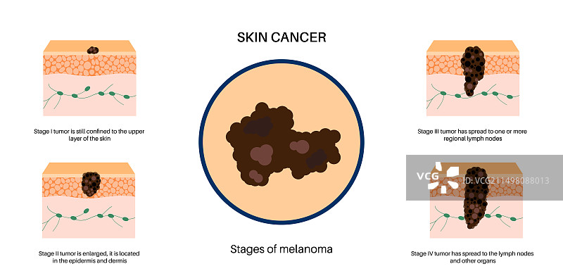 黑色素瘤分期插画图片素材