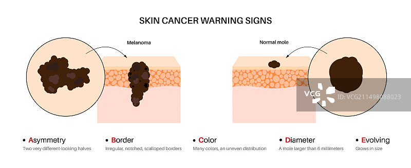 黑色素瘤警告标志插图图片素材