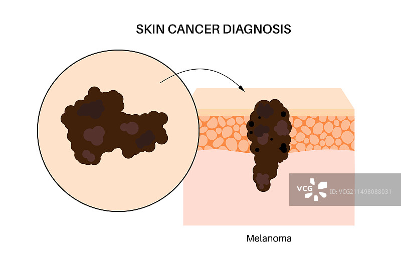 皮肤癌插画图片素材