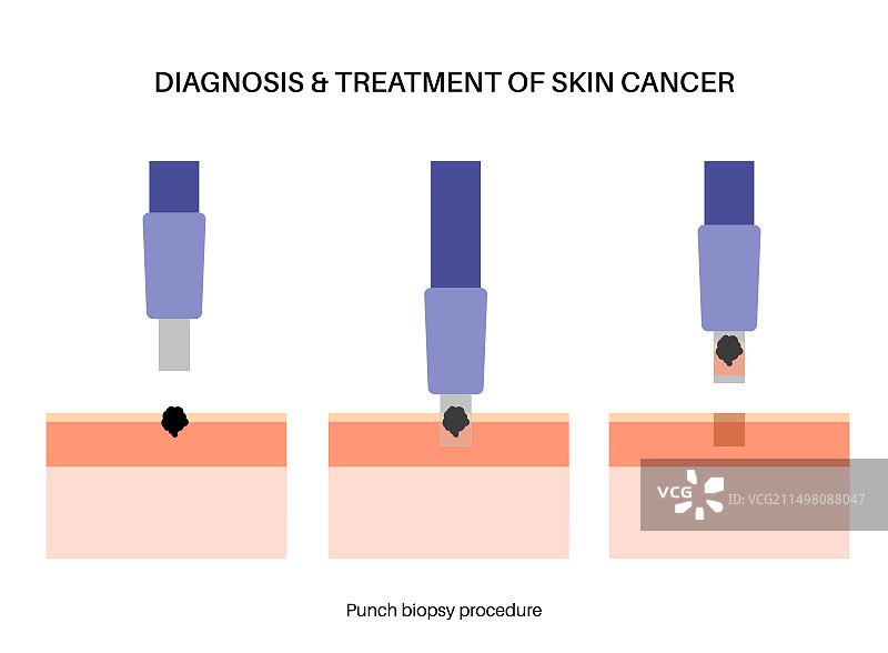 冲压活检图示图片素材