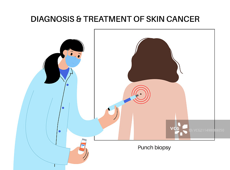 冲压活检图示图片素材