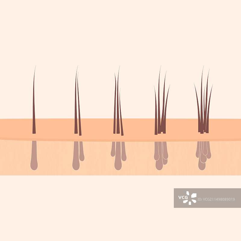 毛发移植类型概念图图片素材