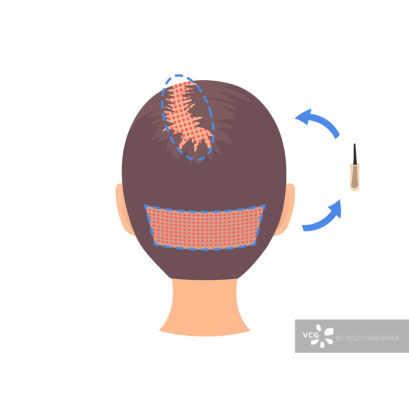 毛囊单位提取（FUE）头发移植概念图图片素材