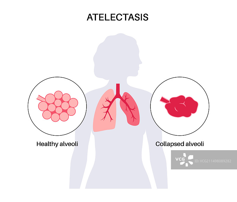 肺不张插画图片素材