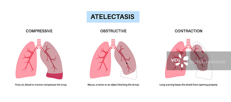 肺不张插画图片素材