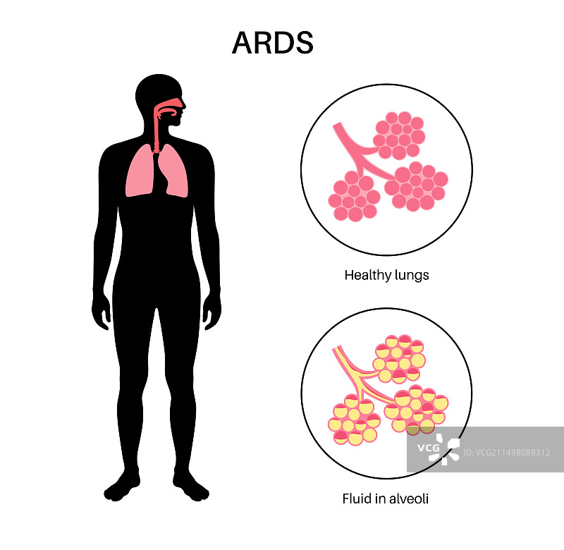 急性呼吸窘迫，图示图片素材