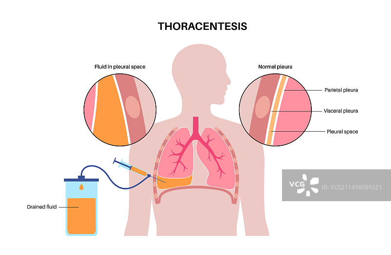 胸腔穿刺术插画图片素材