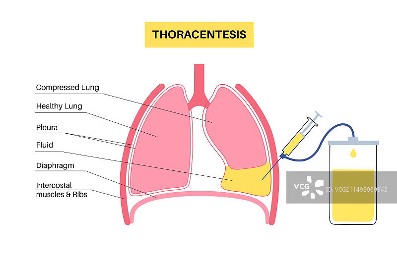 胸腔穿刺术插画图片素材
