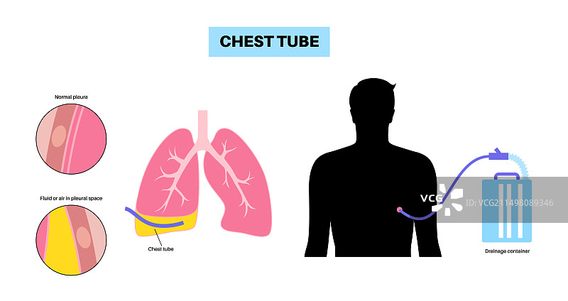 胸管导管插图图片素材