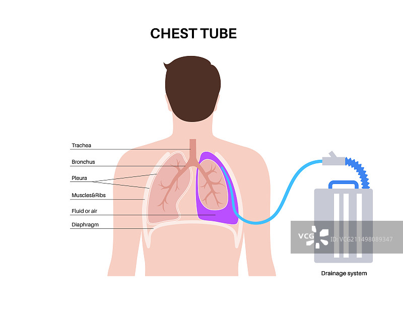 胸管导管插图图片素材