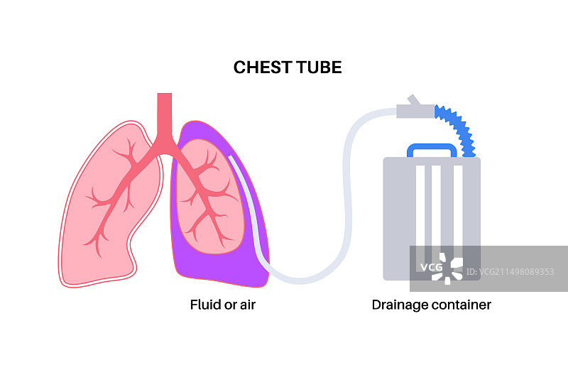 胸管导管插图图片素材