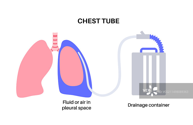 胸管导管插图图片素材