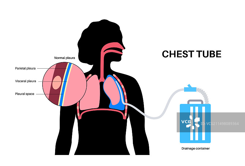 胸管导管插图图片素材