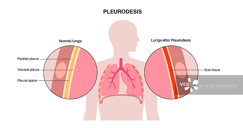 胸膜固定术医疗程序插图图片素材