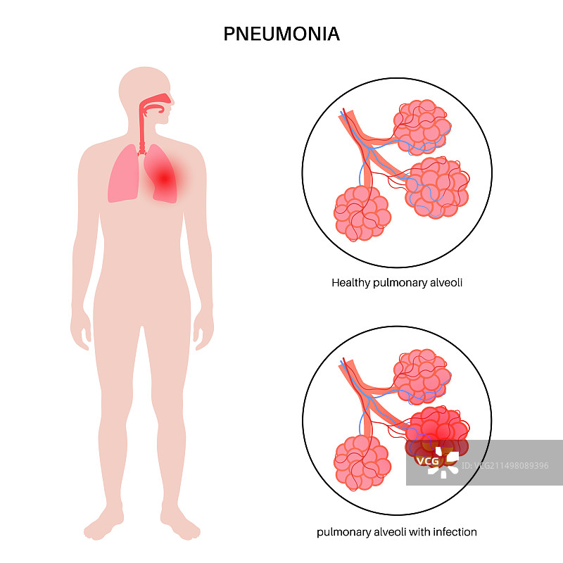 肺炎感染概念图图片素材