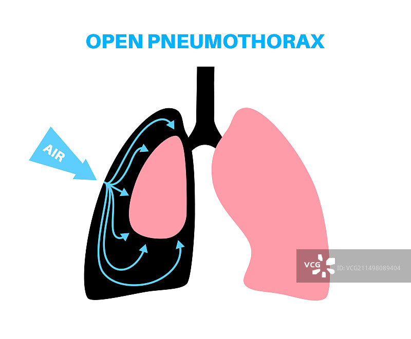 气胸插图图片素材
