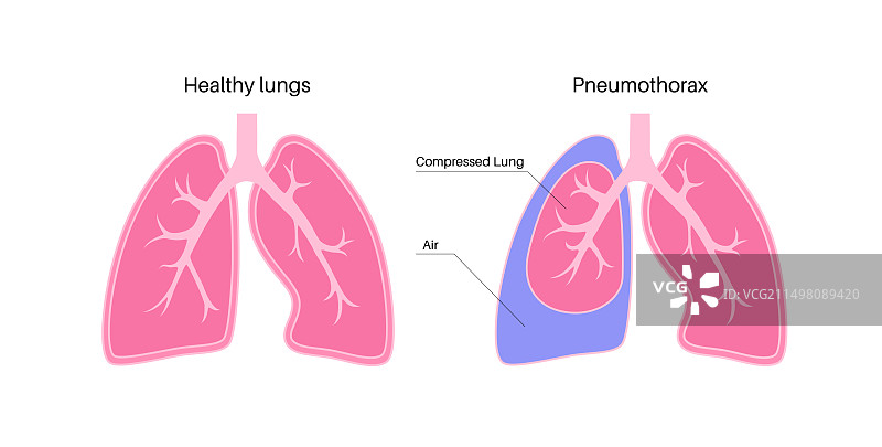 气胸插图图片素材