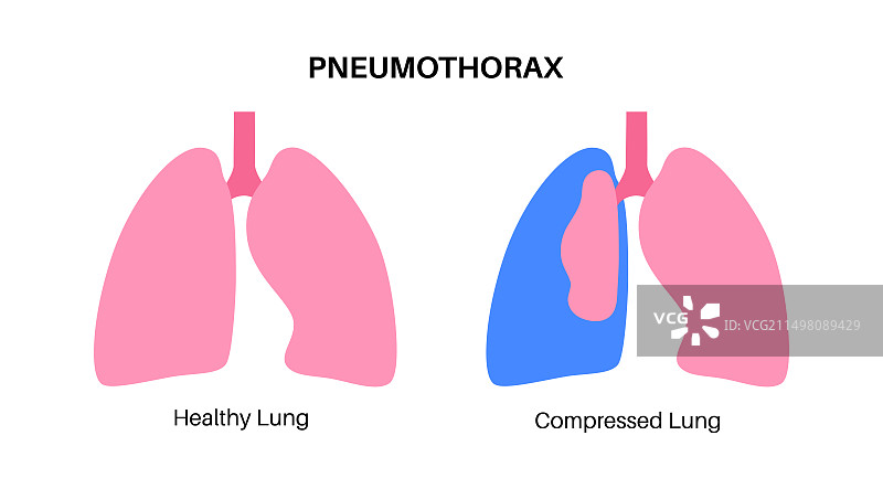 气胸插图图片素材