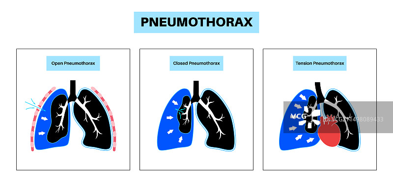 气胸插图图片素材