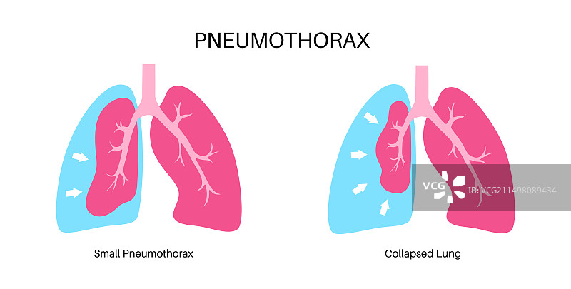 气胸插图图片素材