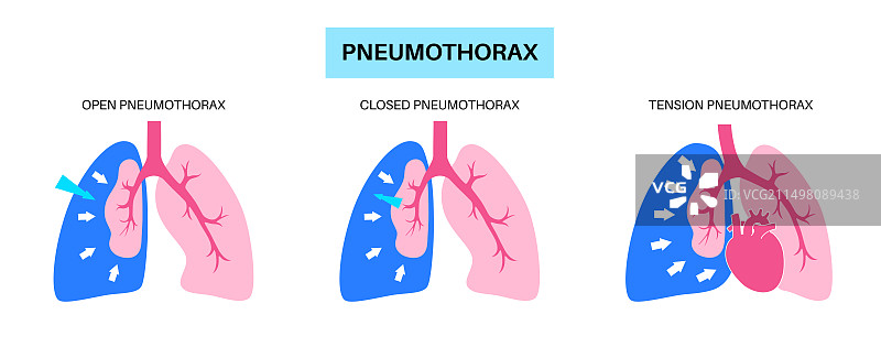 气胸插图图片素材