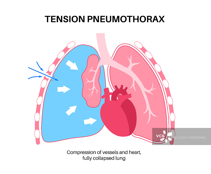 张力性气胸插图图片素材