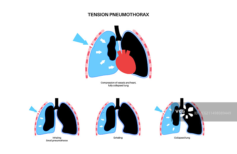 张力性气胸插图图片素材