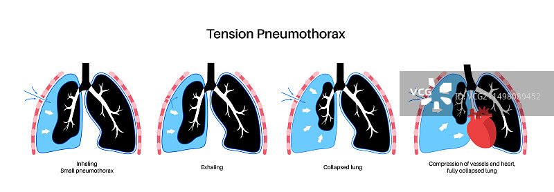 张力性气胸插图图片素材