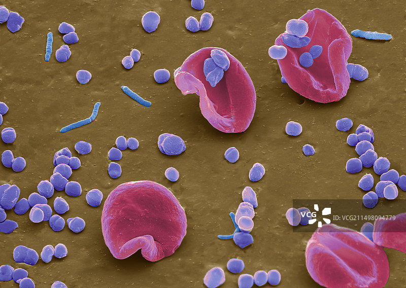 感染的PICC导管，SEM图片素材