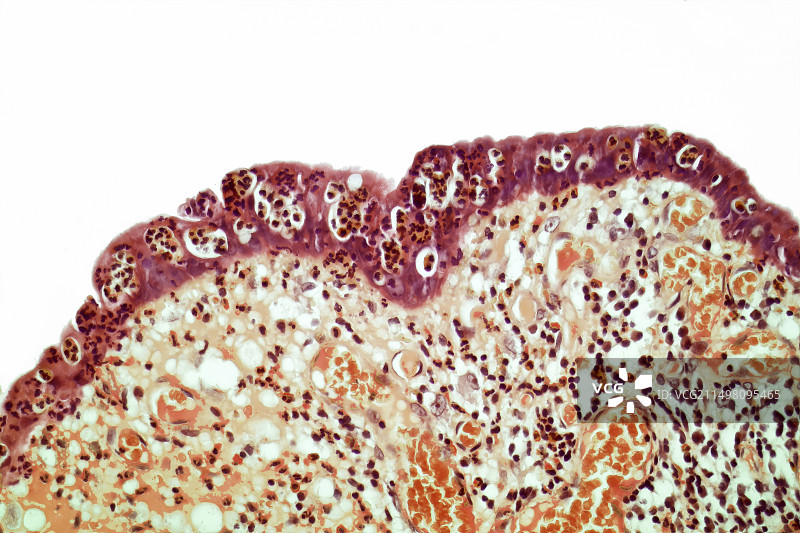 溃疡性结肠炎，LM图片素材