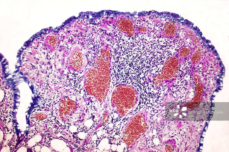 溃疡性结肠炎，LM图片素材