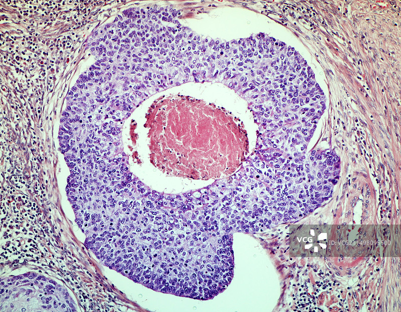 宫颈癌，LM图片素材