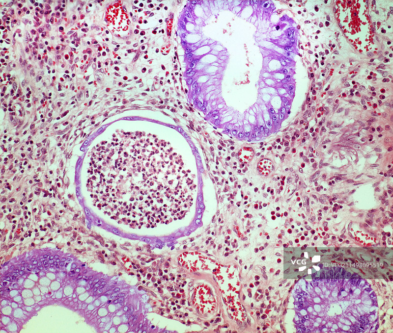 溃疡性结肠炎，LM图片素材