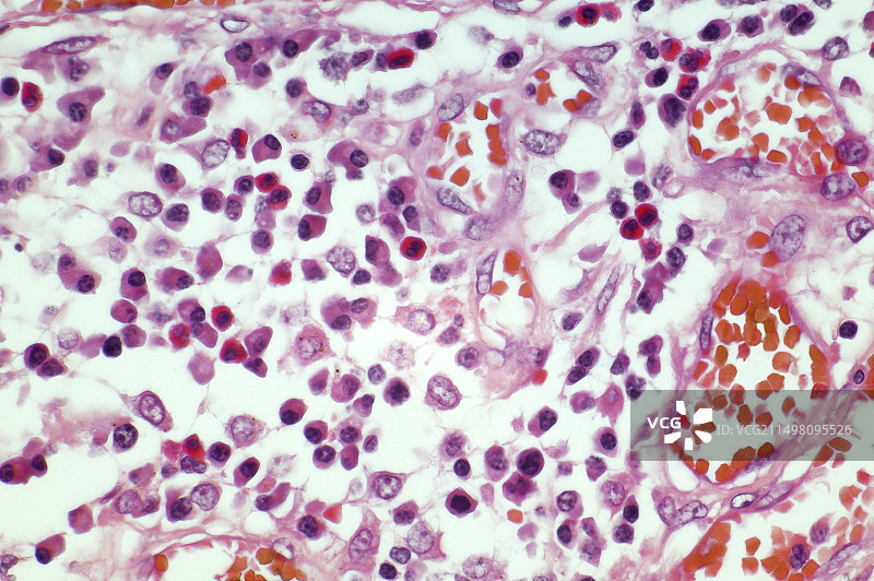 溃疡性结肠炎，LM图片素材