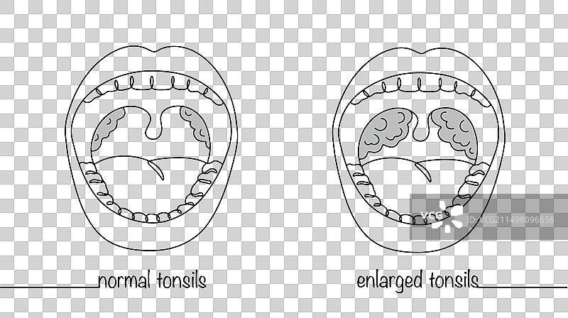 腭扁桃体图片素材
