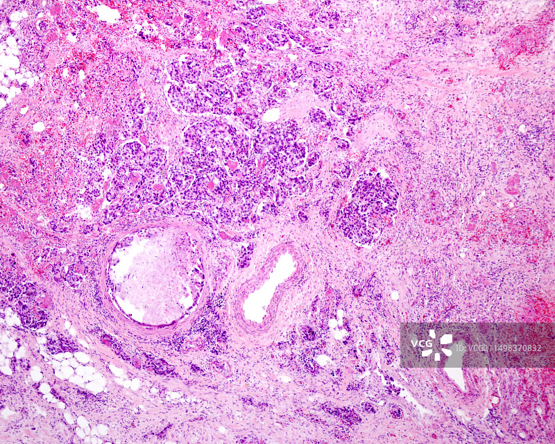 肾上腺皮质癌光学显微照片图片素材