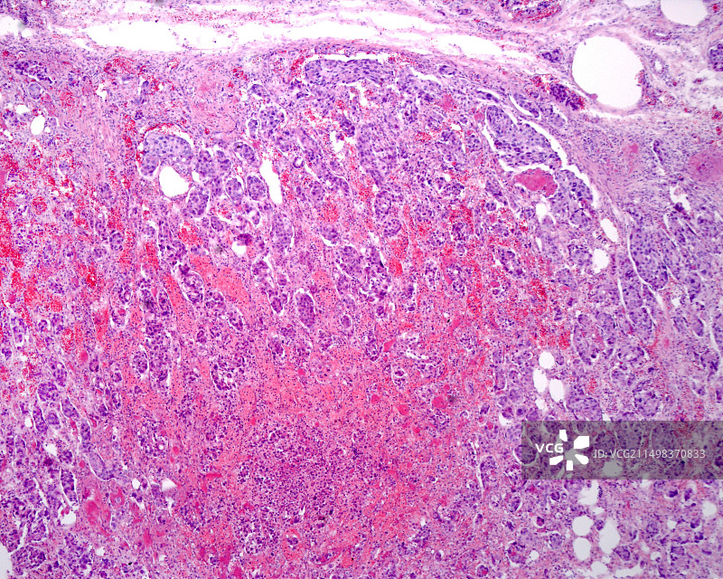 肾上腺皮质癌光学显微照片图片素材