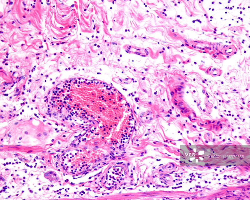白细胞渗出的炎症图片素材