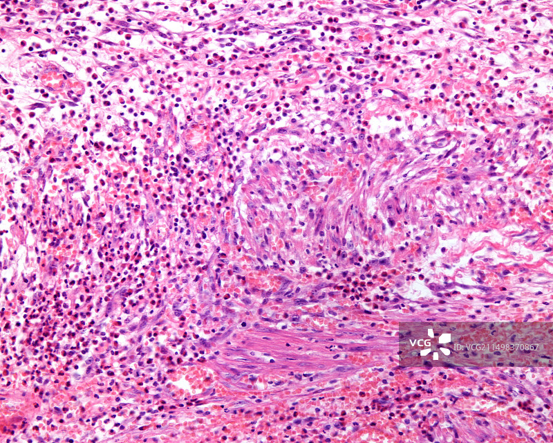 坏疽性胆囊炎，光学显微照片图片素材