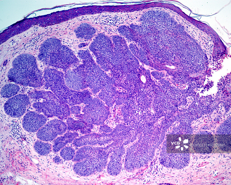 基底细胞癌浅显显微照片图片素材